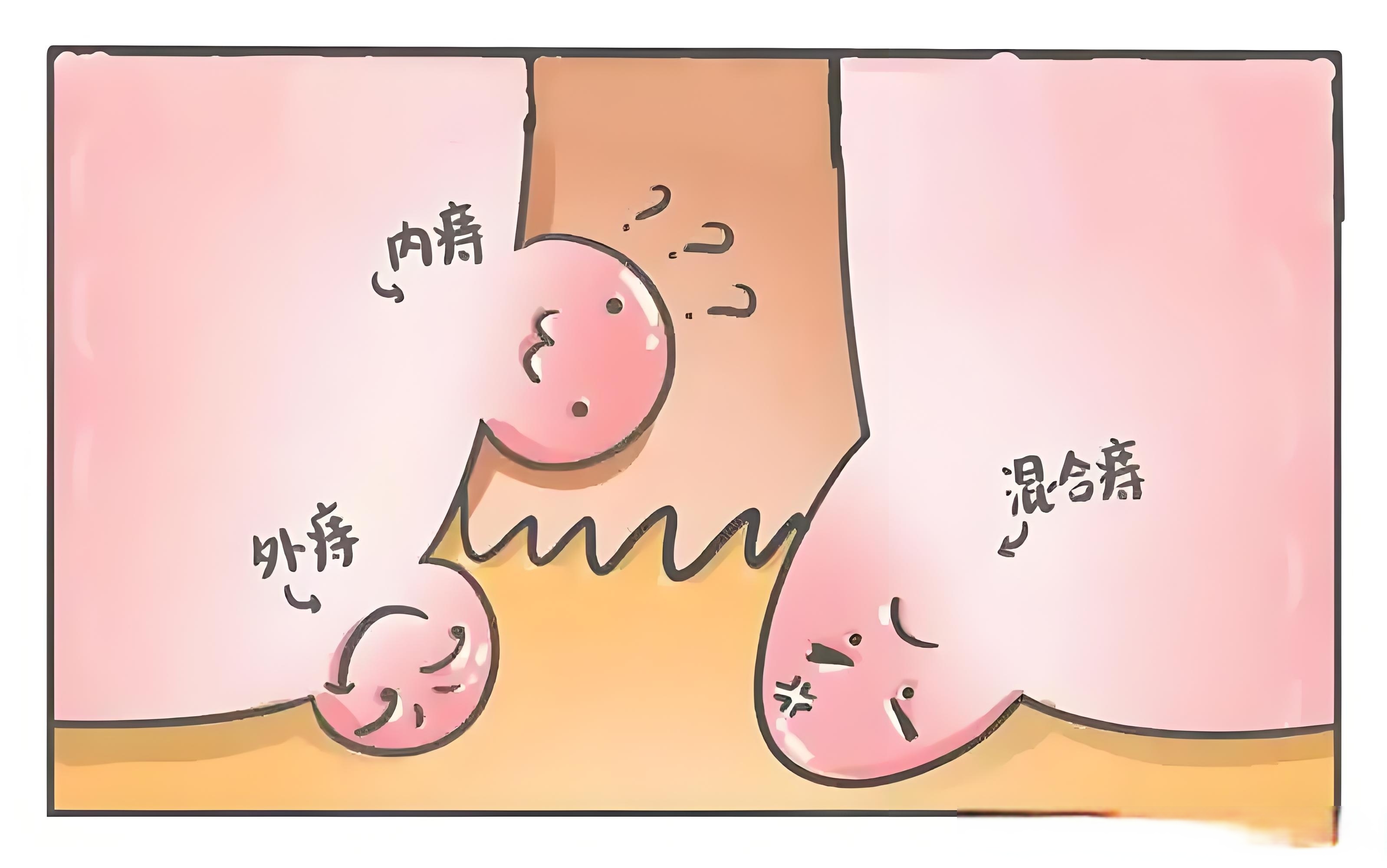 痔疮预防与早治：别让"难言之隐"拖成"大麻烦"