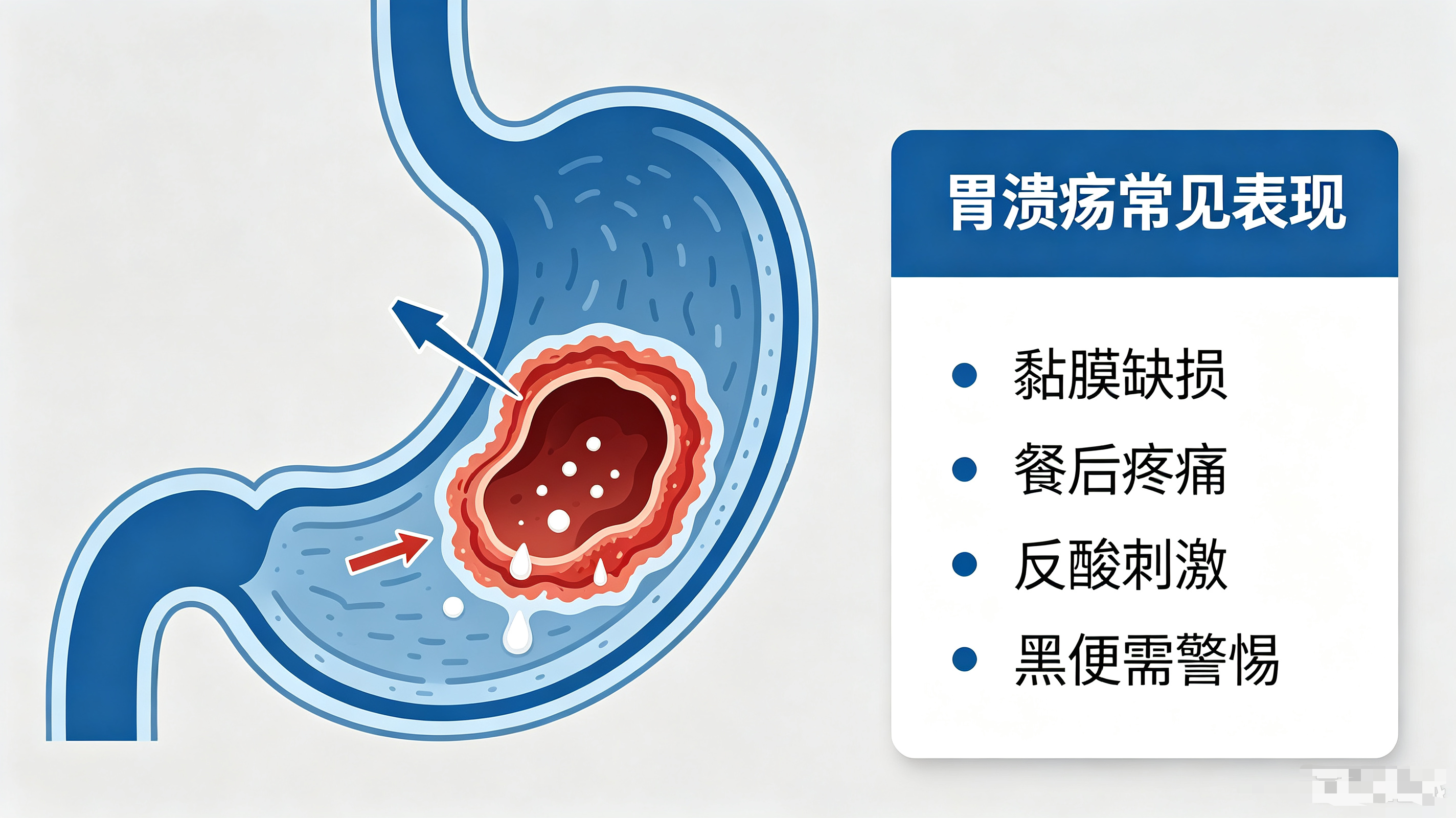 胃溃疡是指胃怎么了
