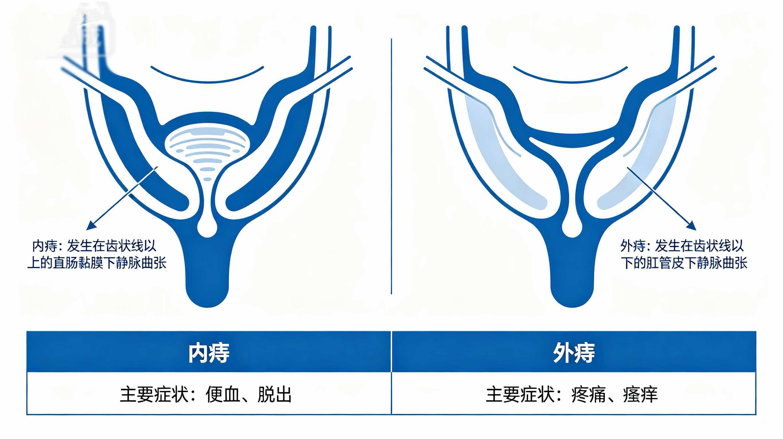 痔疮不是突然长的,肛肠科医生告诉你真相