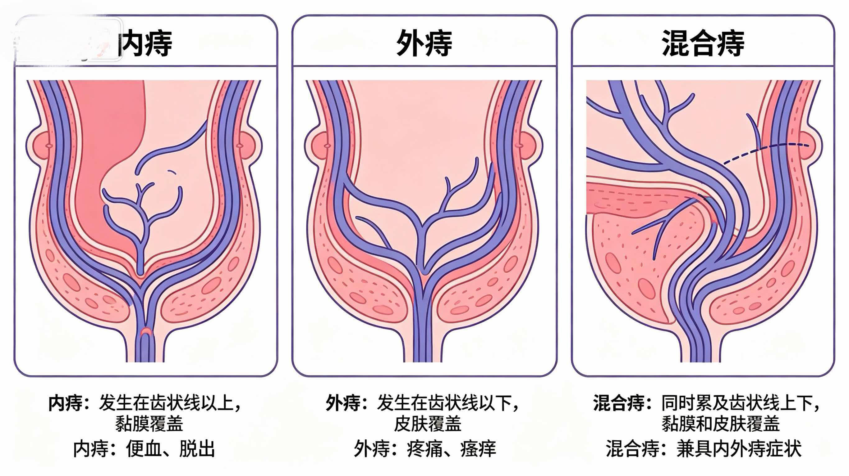 外痔、内痔、混合痔有什么区别