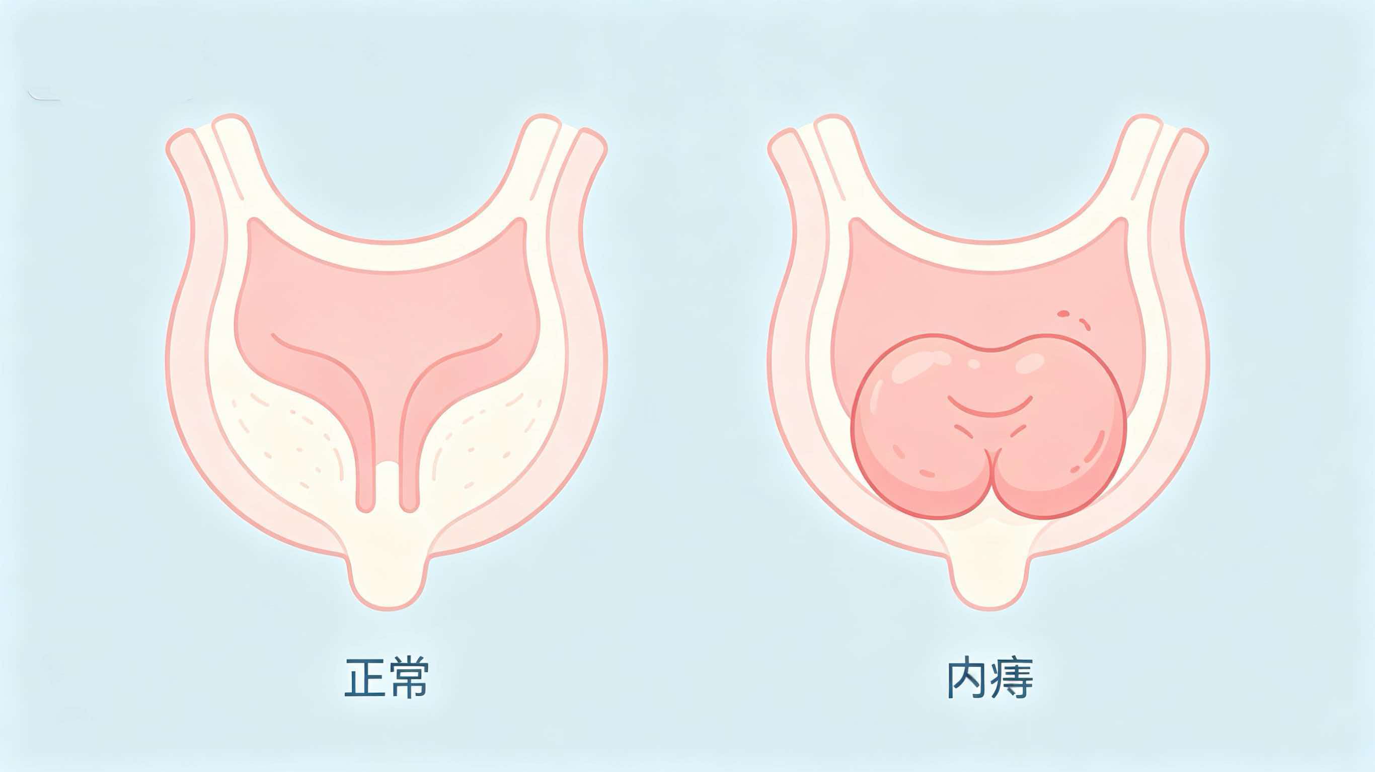 痔疮:最常见的肛肠疾病