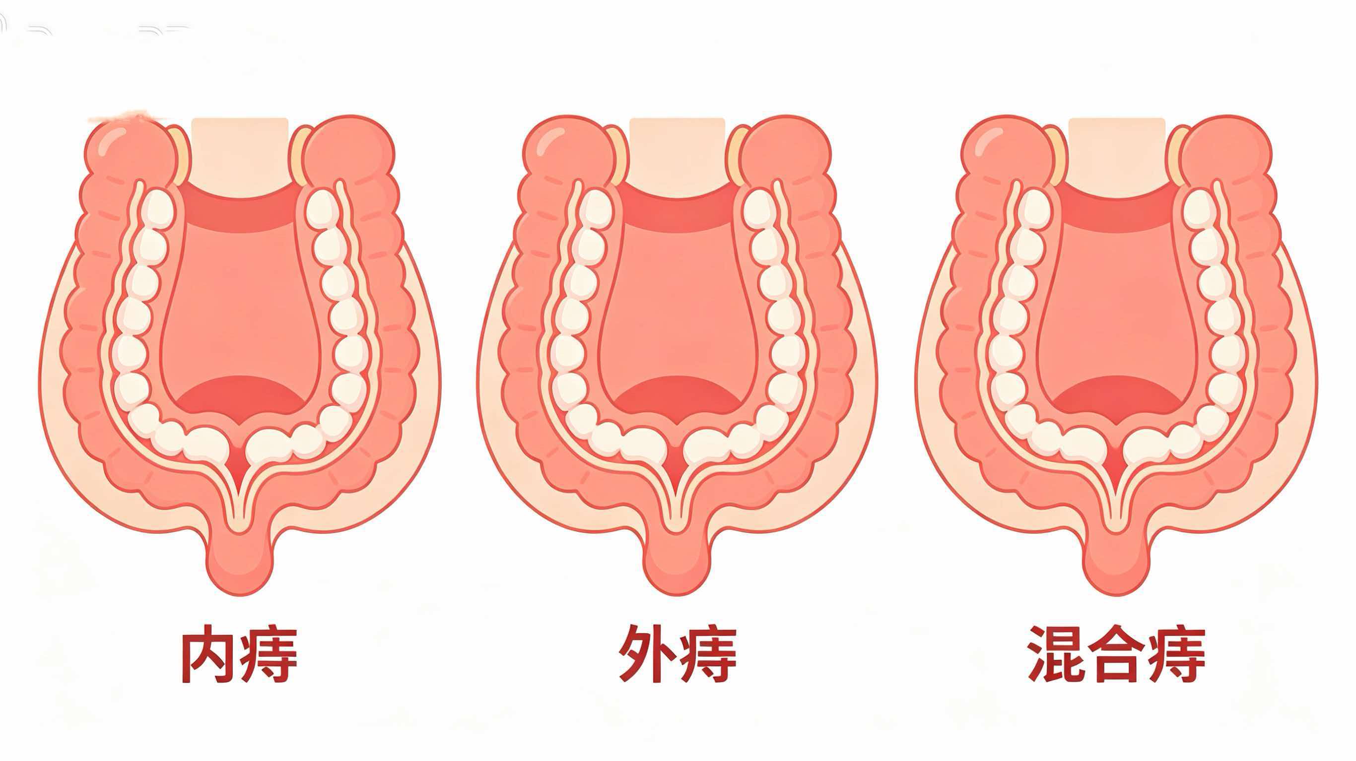 痔疮是怎么回事