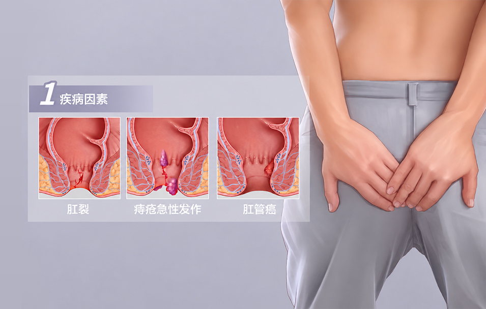 肛门疼痛