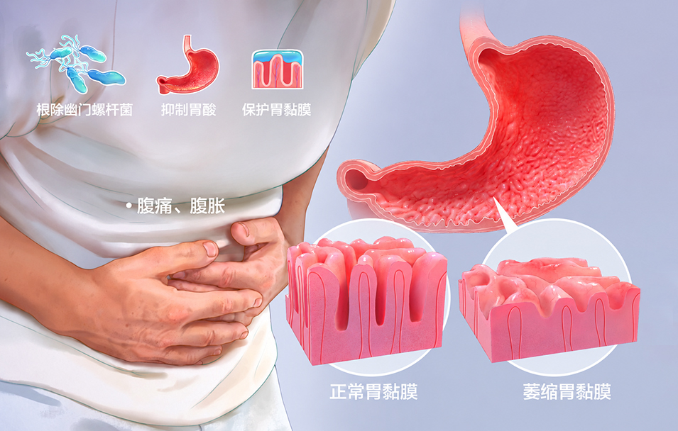 萎缩性胃炎