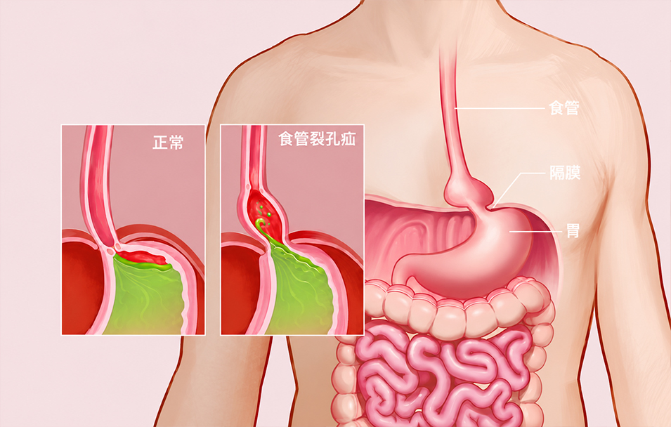 食管裂孔疝
