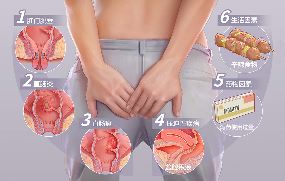 肛门坠胀
