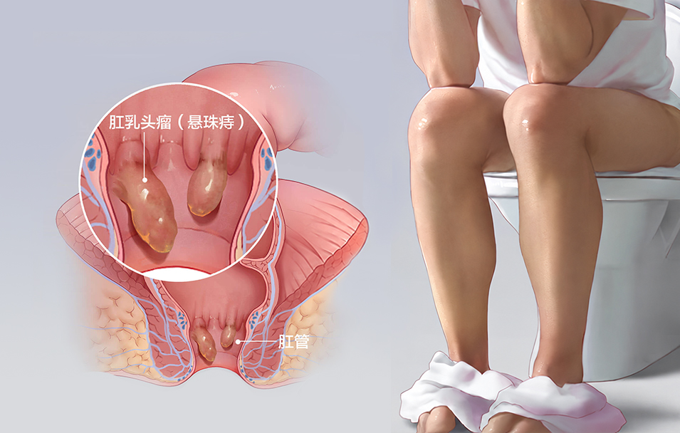 肛乳头瘤
