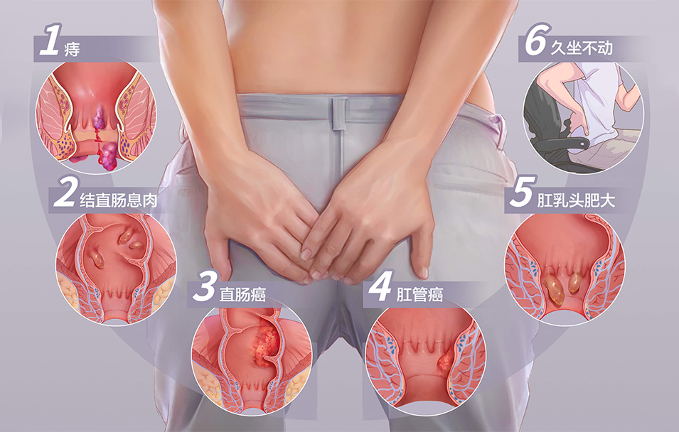 肛门肿物脱出