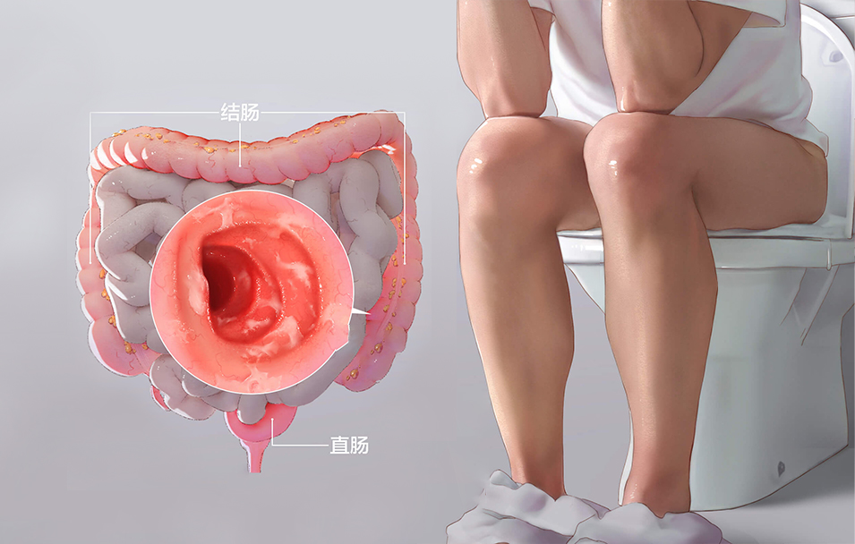 溃疡性结肠炎