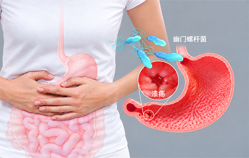 幽门螺杆菌感染