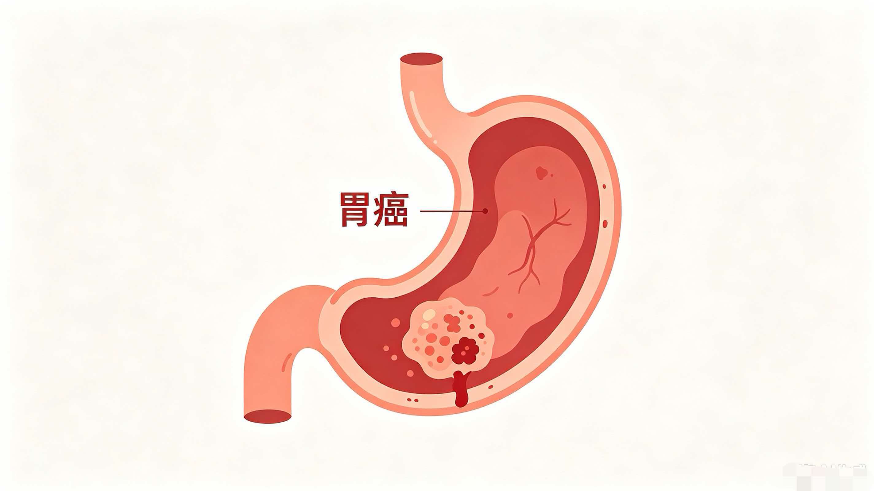 41岁男子胃痛半年未就医，一查已是胃癌中期！这些症状千万别大意
