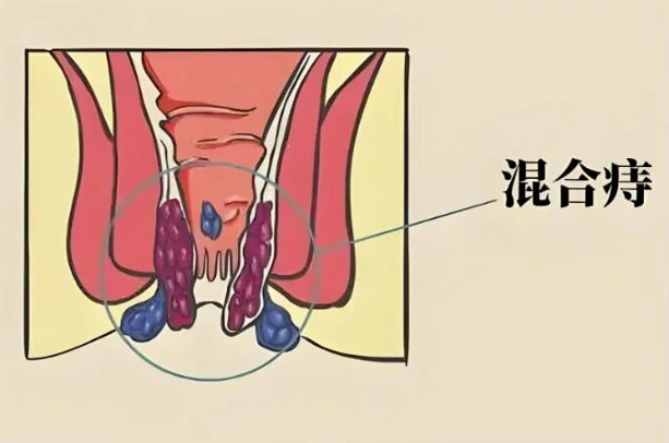 混合痔早期症状:别把“小信号”当上火