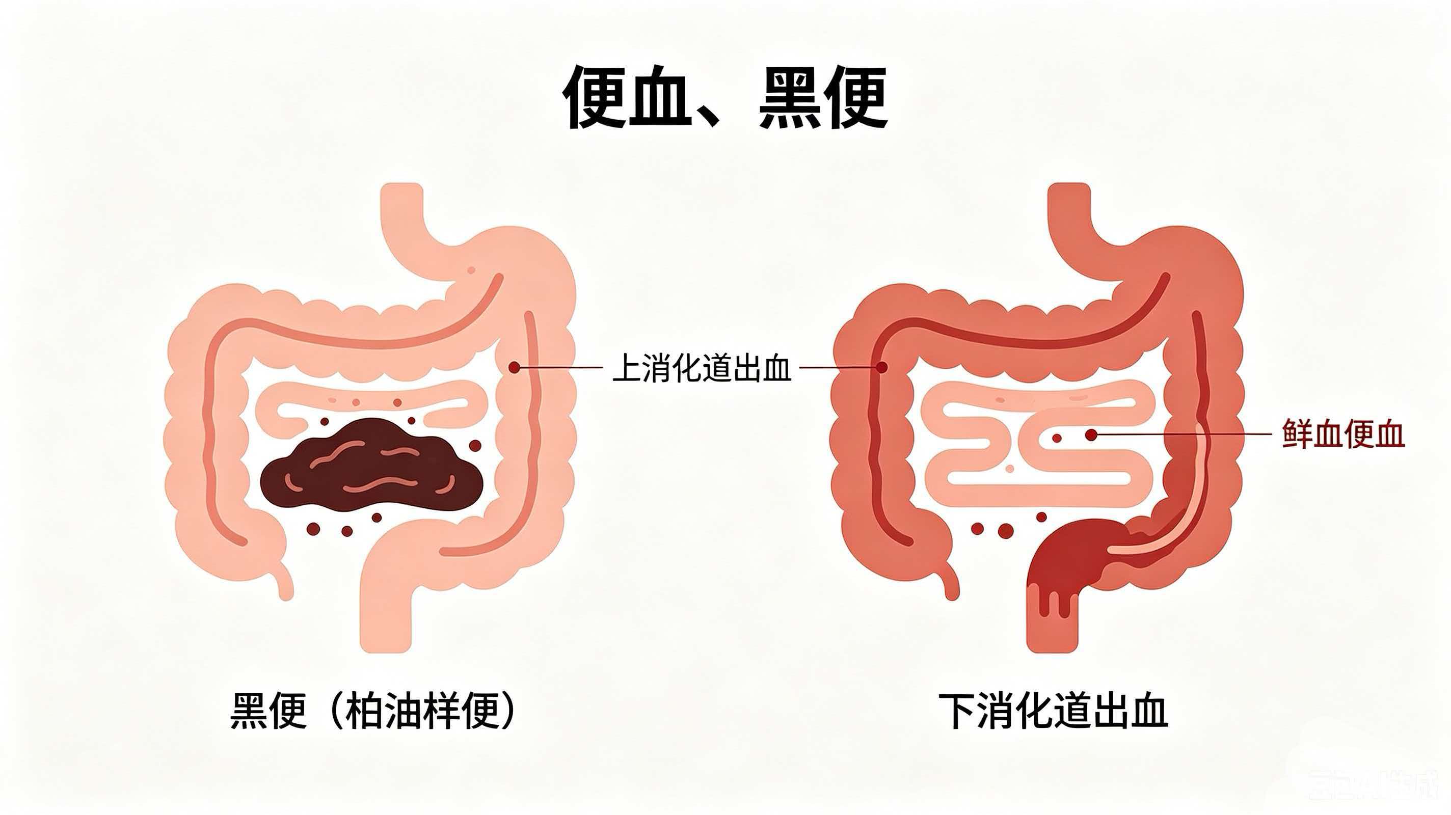 大便出血是怎么回事？别大意，这些原因需了解