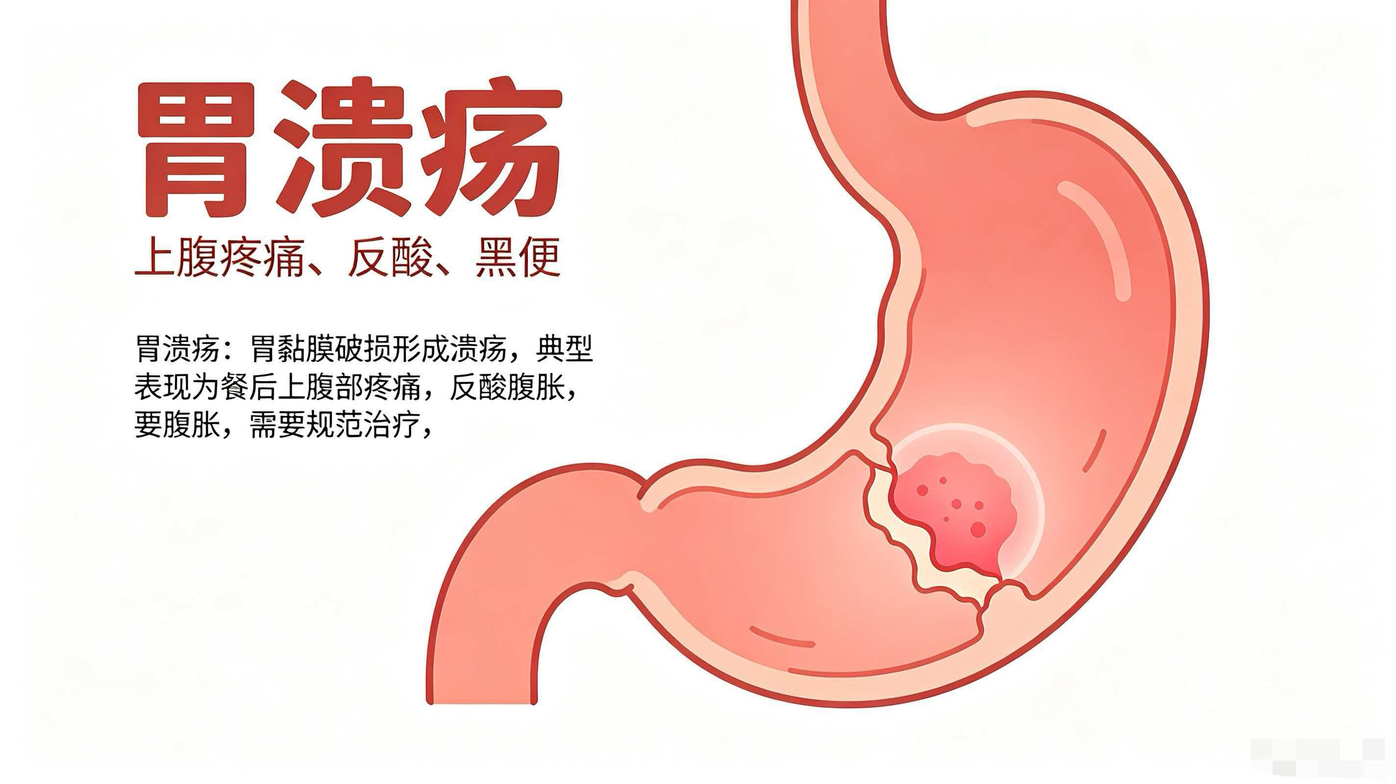 胃炎和胃溃疡的区别