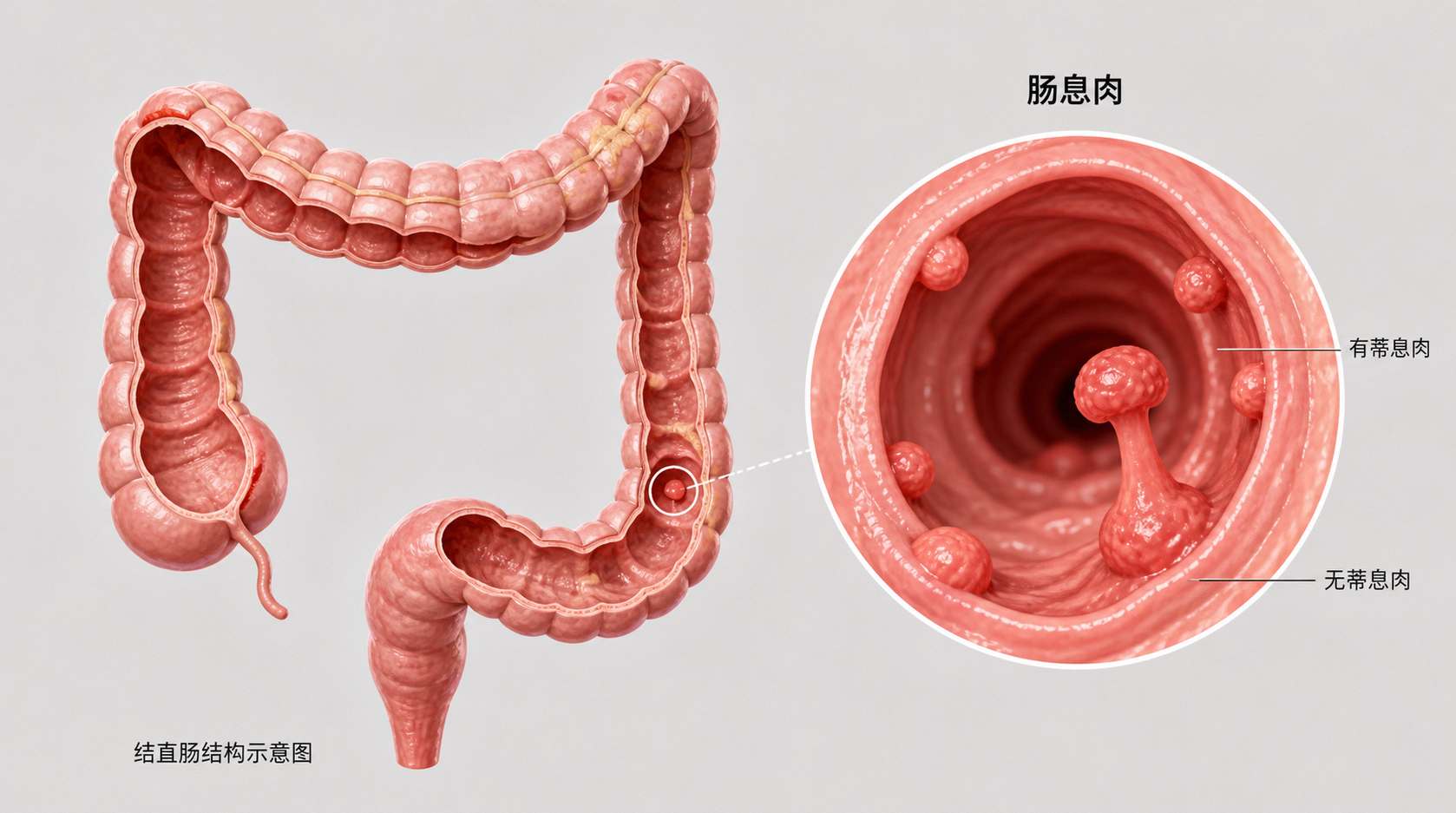 息肉切了又长?医生提醒:这几类高发人群