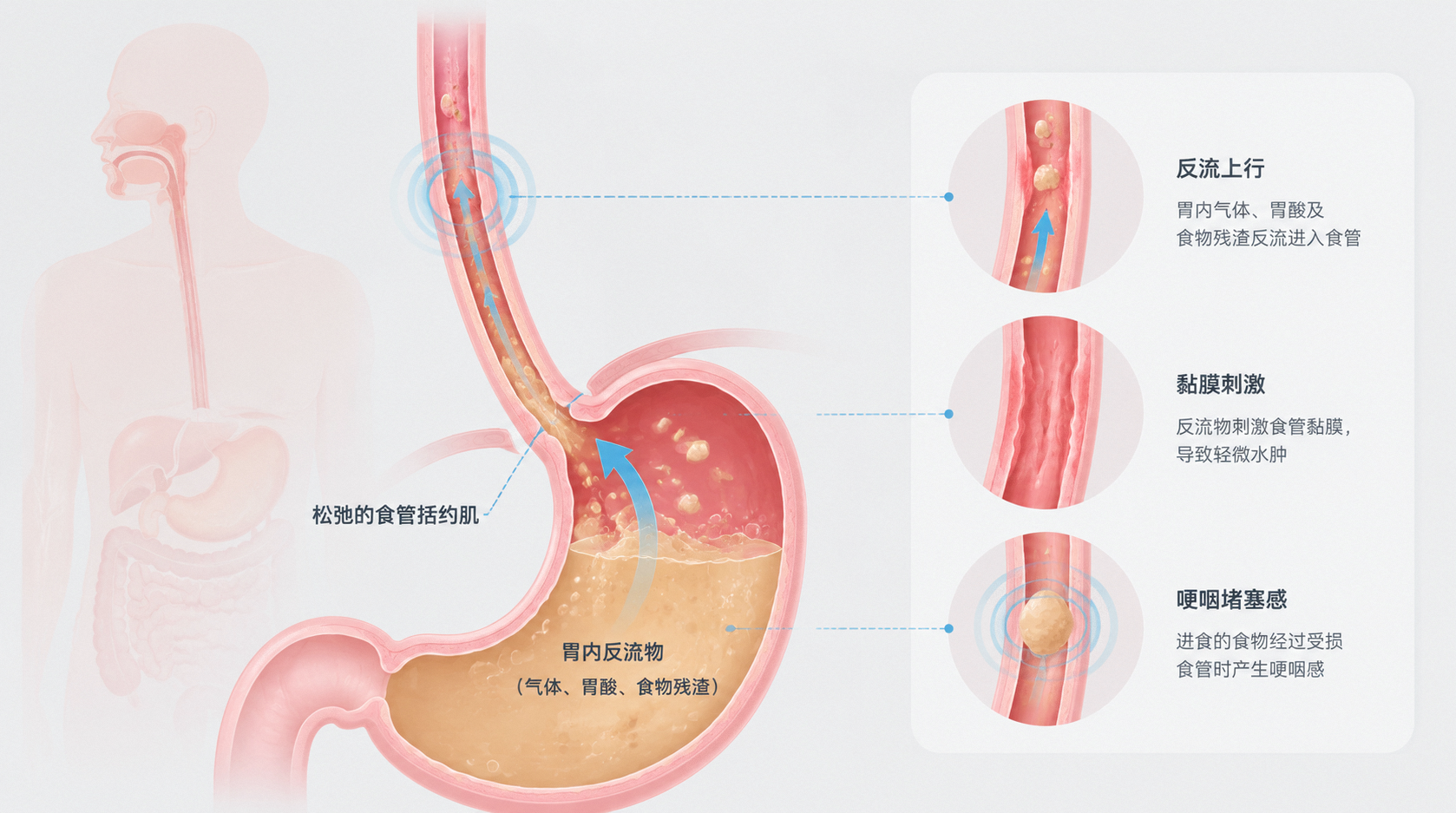 从不抽烟喝酒,52岁男子竟得了食管癌