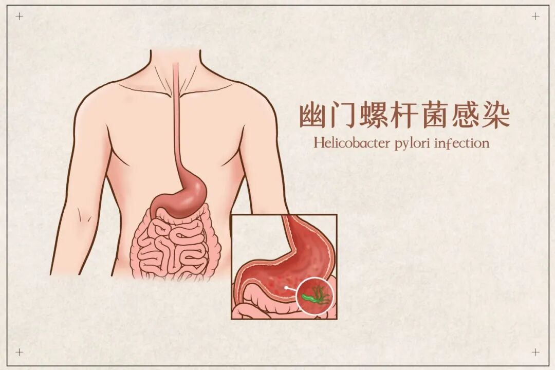 饭后腹胀、反酸、口臭反复？可能是幽门螺杆菌在“作怪”