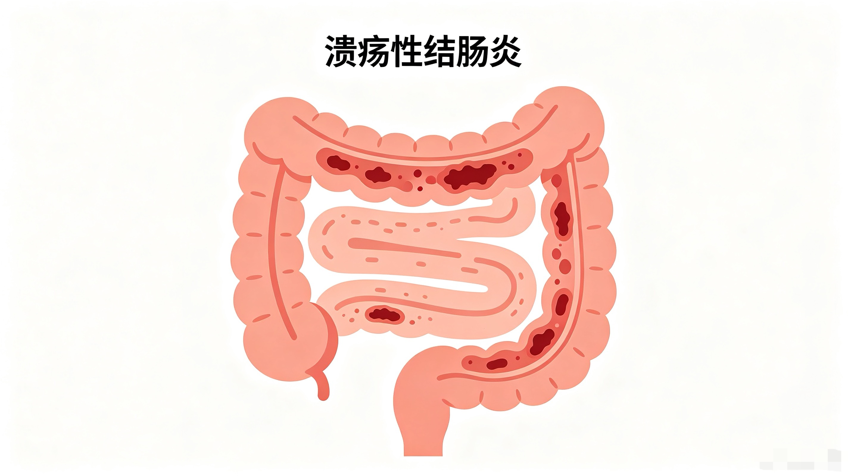 结直肠炎是什么样的疾病