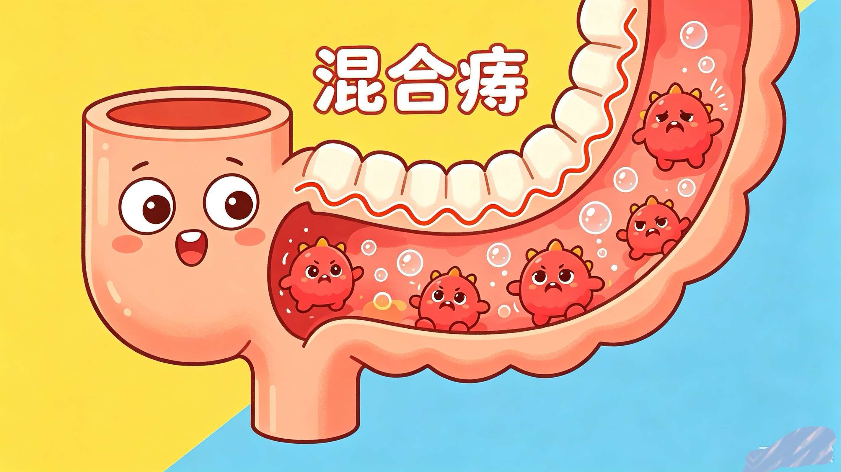 混合痔严重程度分级