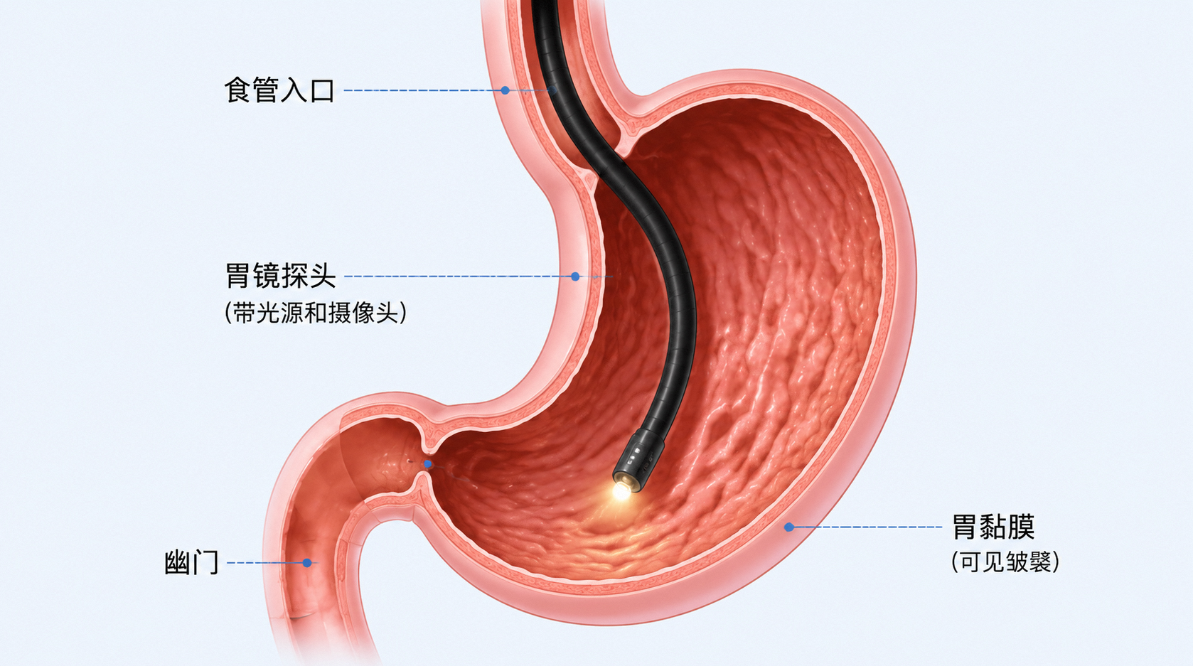肠化生复查时间一览！轻度、中度、重度分别隔多久做胃镜