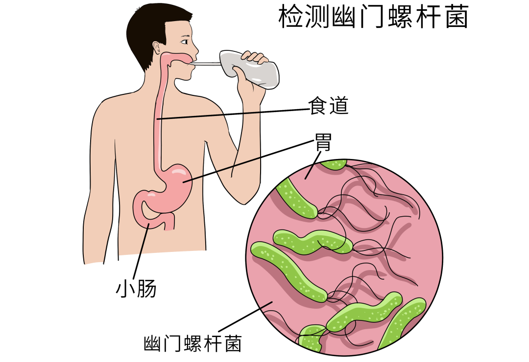 幽门螺杆菌感染症状表现