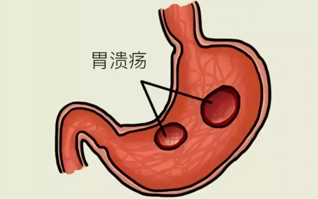 患上胃溃疡的原因