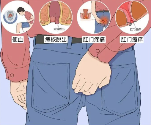 患上痔疮都有哪些症状
