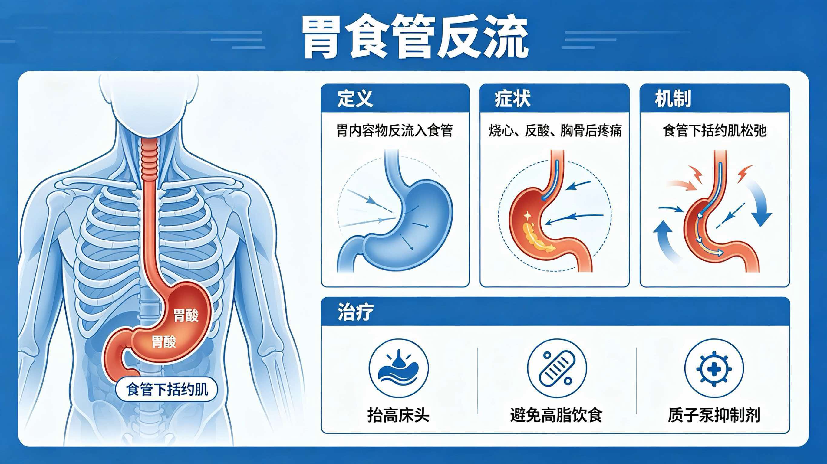 什么是胃食管反流?