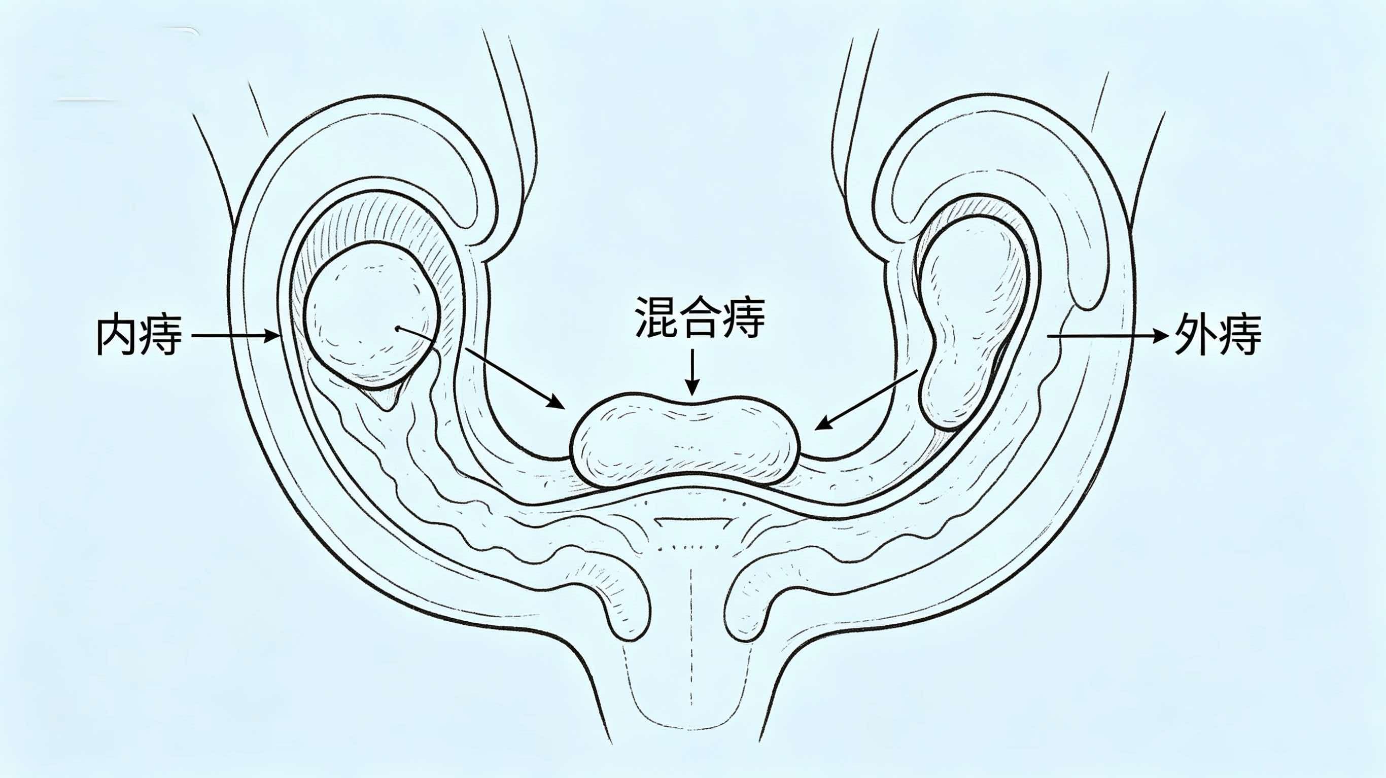 便血背后,可能不只是痔疮在“捣乱”