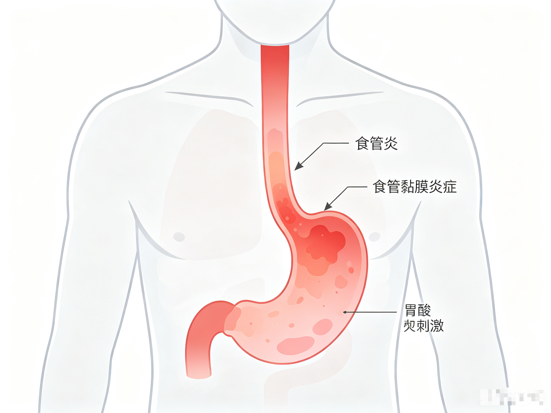 慢性胃炎症状表现