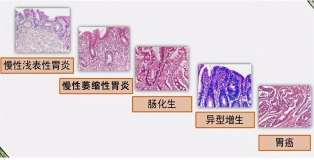 别把慢性胃炎熬成“老胃病”