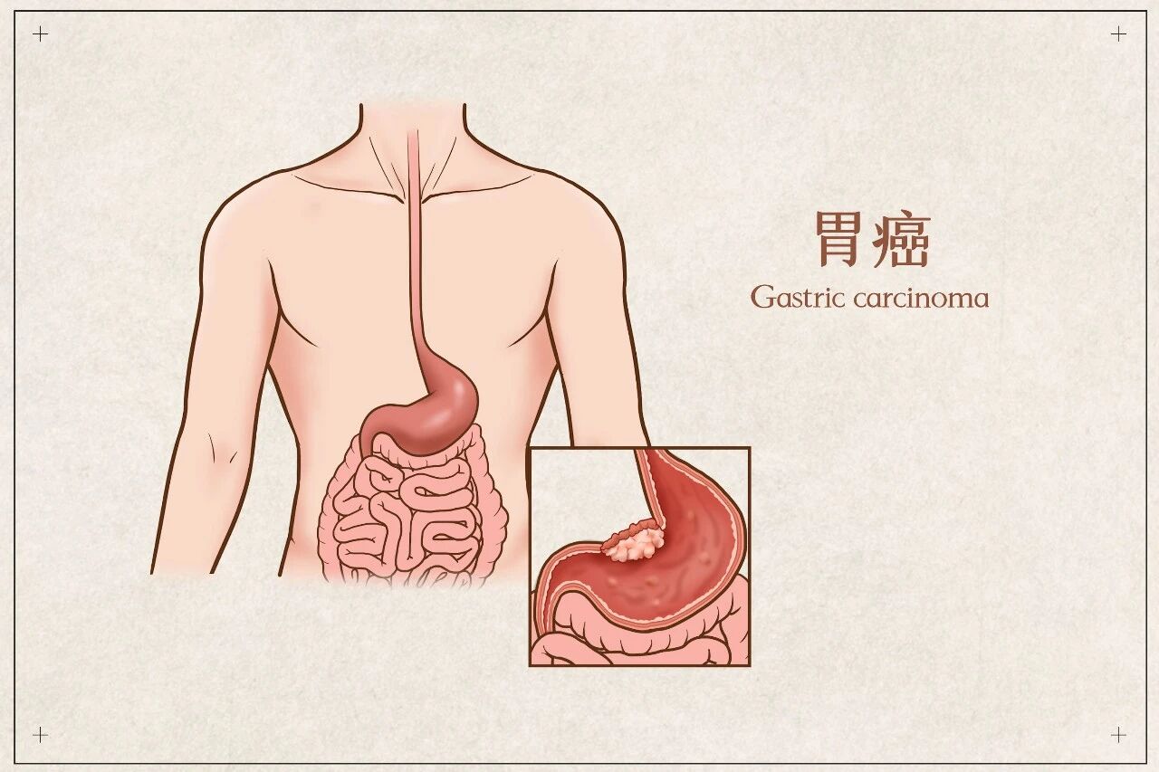 胃癌前期有何征兆